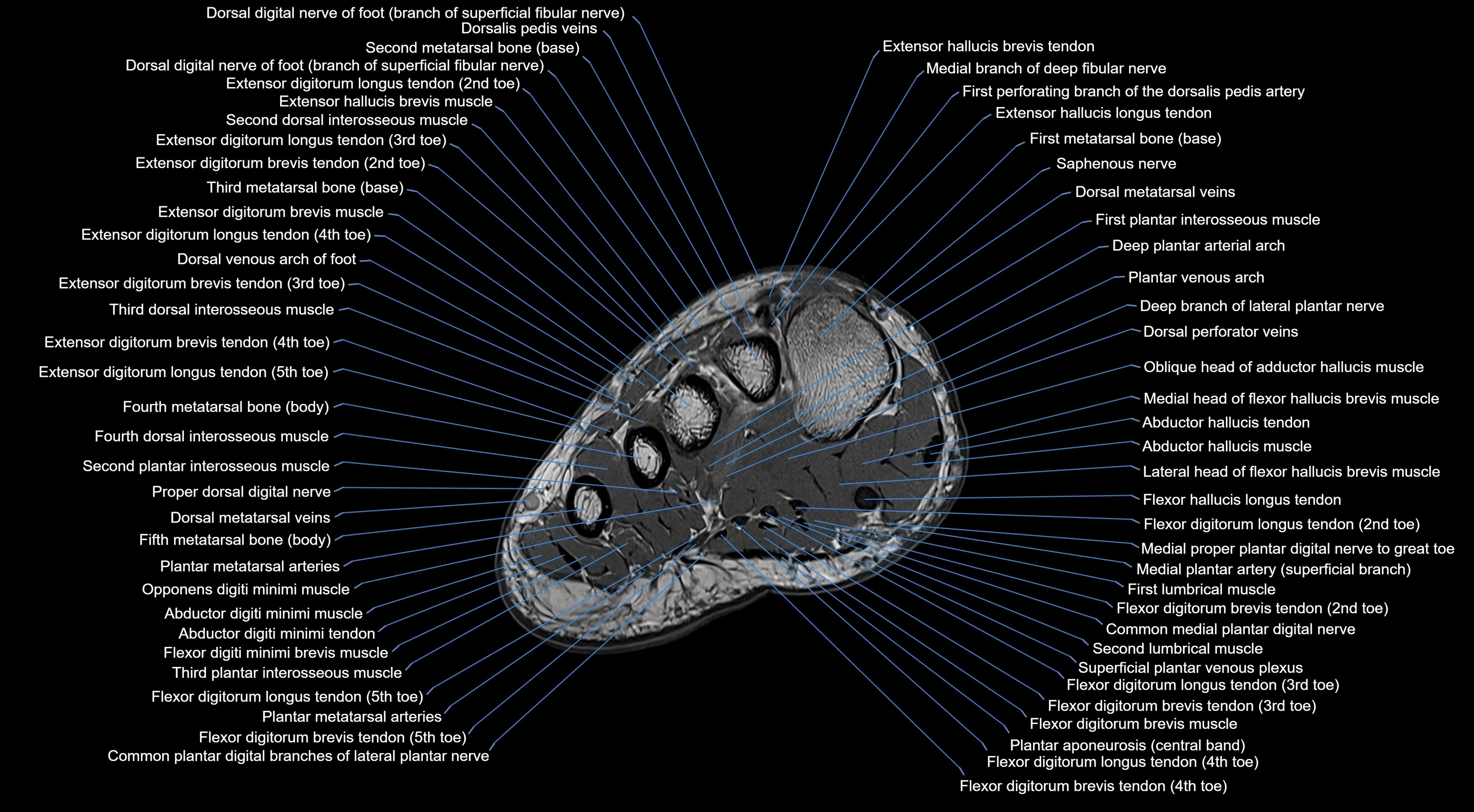 MRI mid foot coronal ligaments cross sectional anatomy 3T  radiology  image-img-00001-00009.webp